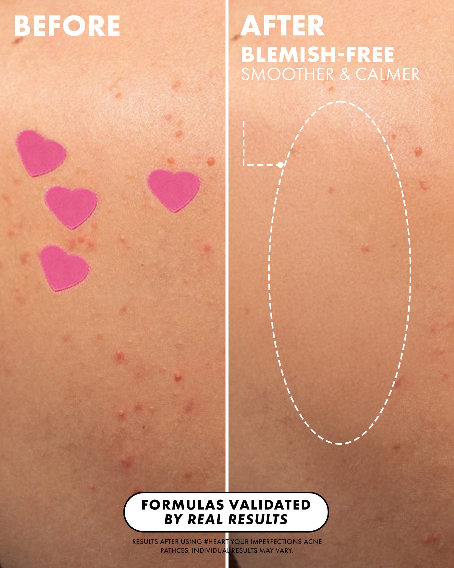 03_BeforeAfter__HeartYourBlemishes_PDP_1500x1875_0cbd123d-9dd5-416b-92da-39e814baf14e.jpg