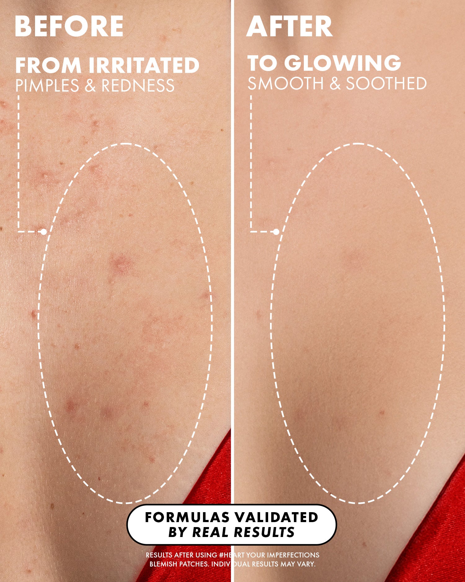 07_BeforeAfterZoomedout__HeartYourBlemishes_PDP_1500x1875_b491e091-546d-4a4b-82db-d9fedbedb8c4.jpg